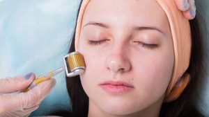 Microneedling Treatment